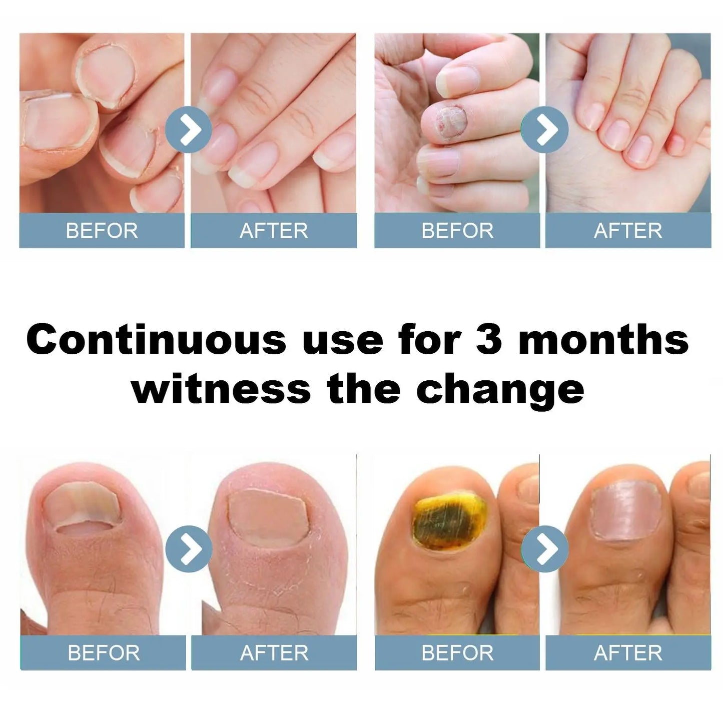 Nail Fungus Cleaning Light Device for Onychomycosis USB Rechargeable 905nm Infrared Light and 470nm Blue Light Nail Care Tool