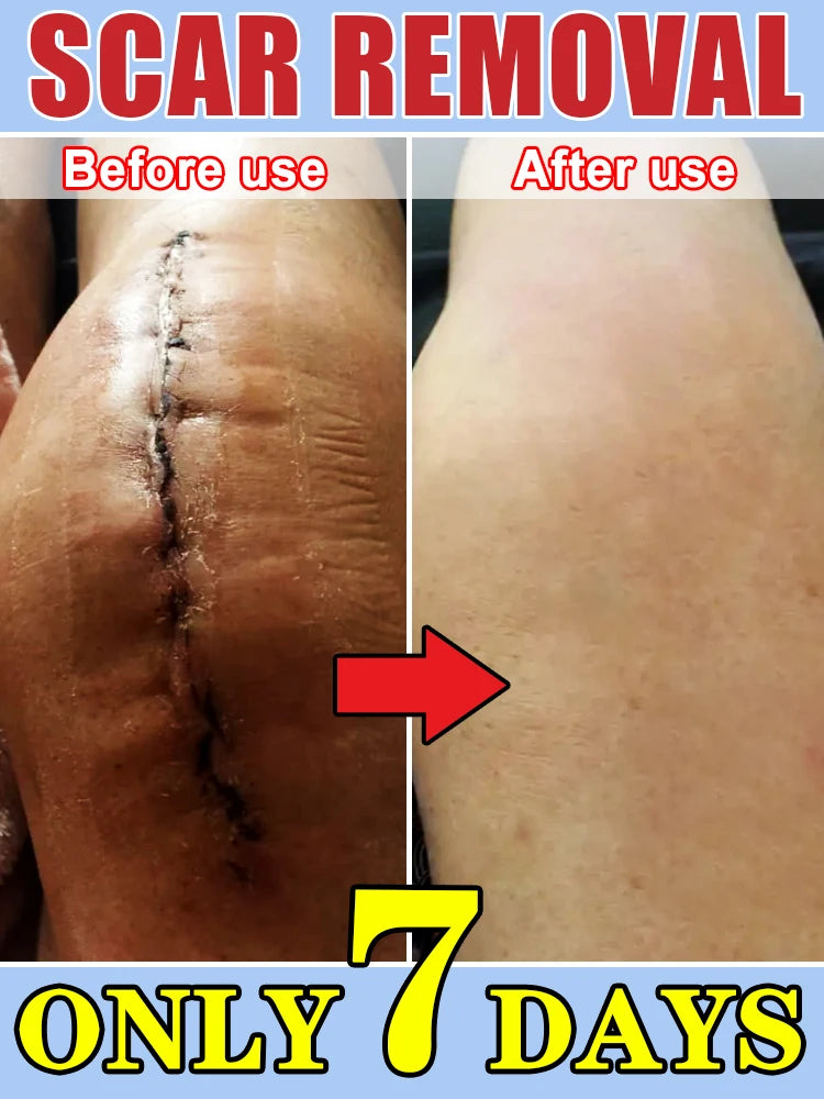After Just One Use Scars Will Disappear And Your Skin Will Be Smooth Flawless And Look Like A New Face Cream