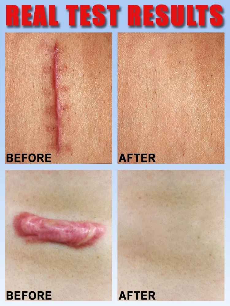 After Just One Use Scars Will Disappear And Your Skin Will Be Smooth Flawless And Look Like A New Face Cream